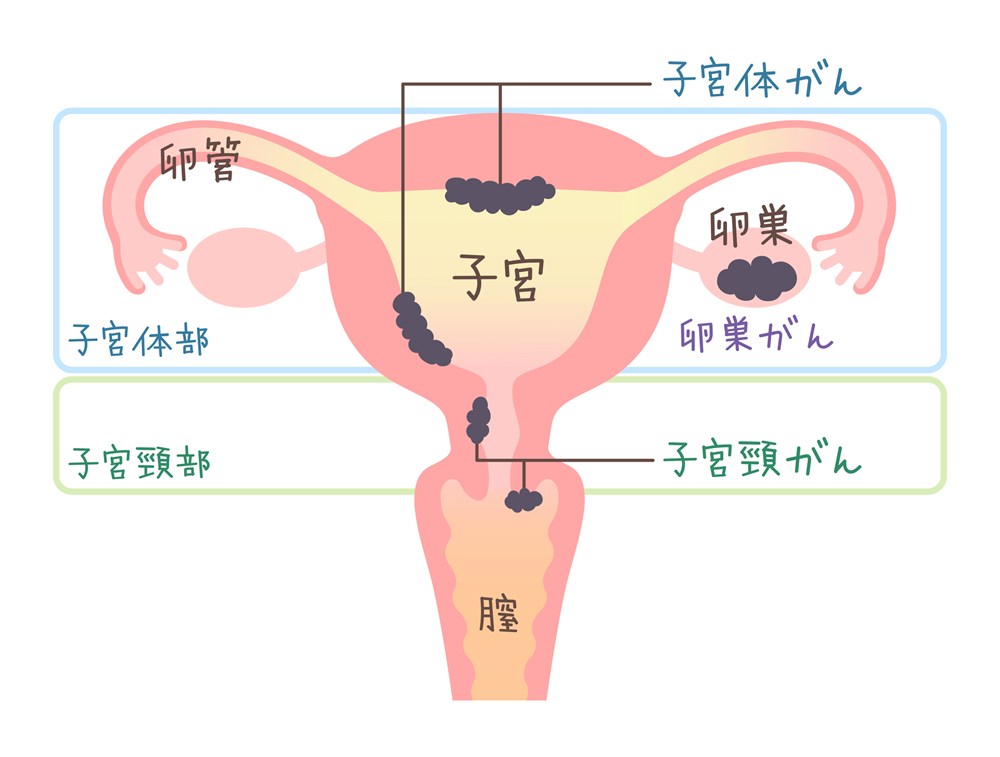 子宮頸がんの主な原因