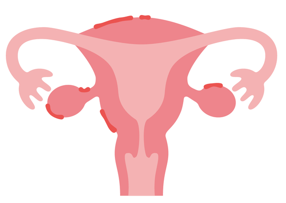 子宮内膜症とは