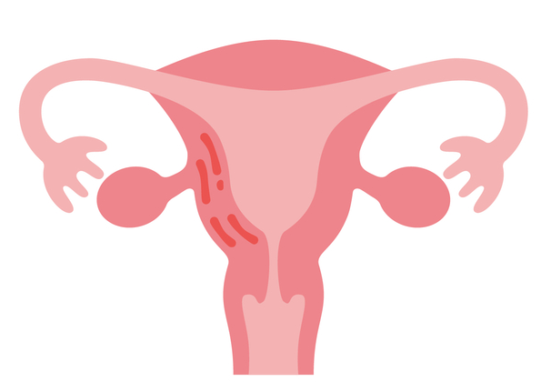 子宮腺筋症とは