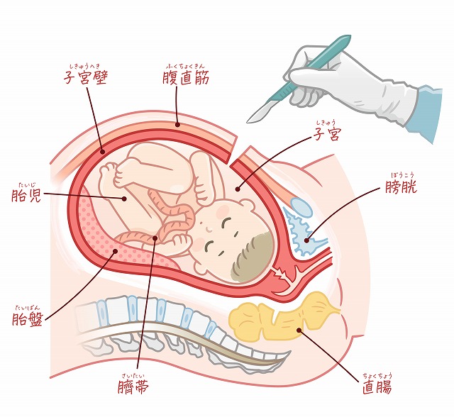 帝王切開とは